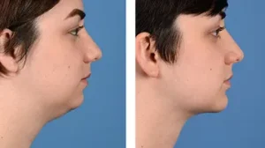 before-after-chin-implant-460x259.width-360.format-webp