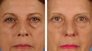 before-after-eyelid-surgery-bleph.width-360.format-webp