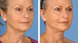 before-after-facelift-1-460x259.width-360.format-webp