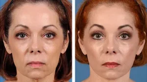 before-after-facelift-2-460x259.width-360.format-webp