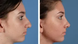 before-after-nose-job-rhinoplasty.width-360.format-webp